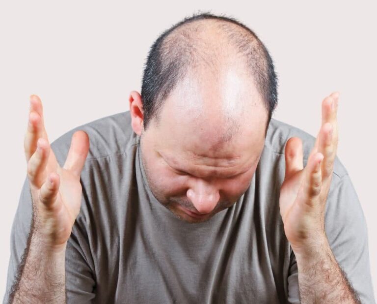 THE SILENT EPIDEMIC: IS THE CURE FOR BALDNESS FINALLY HERE?